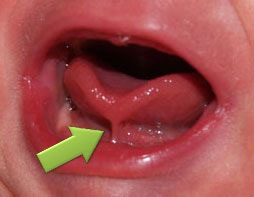 tonguetie2